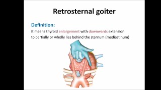 Retrosternal goiter [upl. by Gillette]