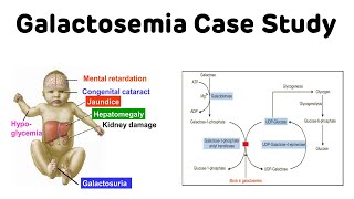 Galactosemia Case Study  Classical Galactosemia  NEXT PG Biochemistry [upl. by Hoxsie]