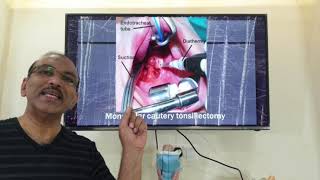 Techniques of tonsillectomy  HINDI Patient teaching programme [upl. by Lleneg]