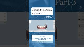 Clinical Indications Crowding Part 3 [upl. by Nnod]