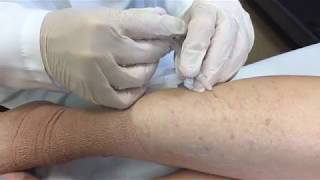 Varicose Vein Treatment  George Anton MD [upl. by Ob]