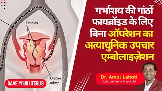 Uterine Artery Embolization UAE Explained amp Live Surgery by Dr Amol Lahoti [upl. by Anifled62]