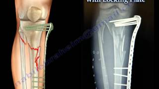 External Fixation With Locking Plate  Everything You Need To Know  Dr Nabil Ebraheim [upl. by Letsirhc]