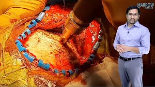 E6 Sample Video Epidural amp Subdural Hematoma Surgery [upl. by Henden43]