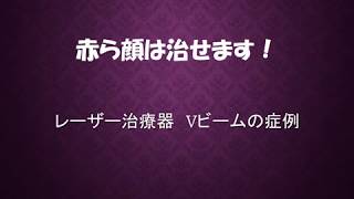 赤ら顔治療 Vビームの症例紹介 video [upl. by Buote]