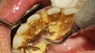 How to remove TARTAR from Teeth  Tartar removal before and after [upl. by Afital]