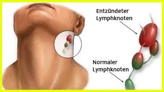 Entzündung der Lymphknoten [upl. by Pattani]