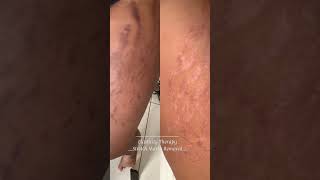 Stretch mark removal for Indian skin tones [upl. by Ppilihp]