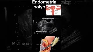 Endometrial Polyp Case Study A StepbyStep Diagnosis health ultrasound polyp DrSaimakhan [upl. by Antoinette]