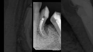 ReRct of 34 and 35 rct premolar shortvideo endodontics [upl. by Oicneserc]