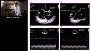 Imaging the Patient with Left Ventricular Assist Device Jerry Estep MDSu Min Chang MD [upl. by Graces]