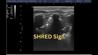 Shred Sign on Lung Ultrasound  Point of Care Ultrasound  Short Video [upl. by Mat]