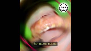 Silent Reflux Laryngopharyngeal reflux Effects on Teeth [upl. by Eldreeda]