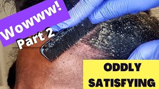 Oddly Satisfying Insane Dandruff Scratching Flakes Scalp Condition Removal After Braids Pt 2 [upl. by Hacceber]