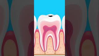 Pulpitis y Necrosis Dental en 1 minuto fyp viralvideo odontologia trending trrndingshorts [upl. by Liggett]