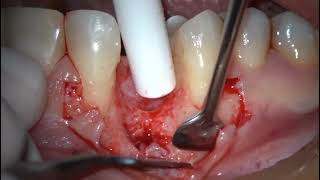 GBR Soft Tissue Dental implantation Dr Venci Stankov [upl. by Kcinom]