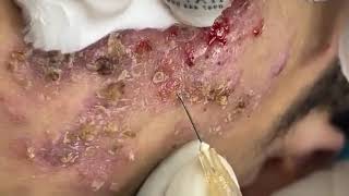 BEST BLACKHEAD AND WHITEHEAD REMOVAL SEVERE ACNE TREATMENT  SATISFYING AND RELAXING VIDEO [upl. by Niffirg]