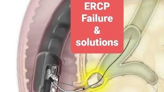 ERCP procedure failures and their solutions [upl. by Llemaj]