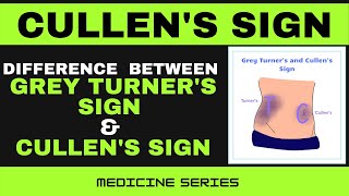 CULLENS SIGN I ACUTE PANCREATITIS I DIFFERENCE BETWEEN CULLENS AND GREY TURNERS SIGN [upl. by Eloccin]