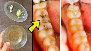 Best Home Remedies for Toothache Pain  Instant Pain Relief [upl. by Asemaj]