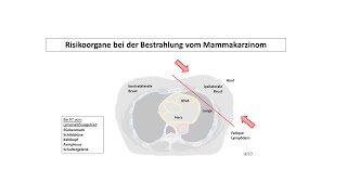 Risikoorgane bei der Bestrahlung vom Mammakarzinom  Strahlentherapie Prof Hilke Vorwerk [upl. by Loar]