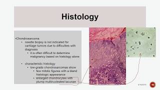 Chondrosarcoma [upl. by Clapp]