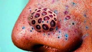 Blackheads Blackhead Removal and Trypophobia Disease [upl. by Buehrer]