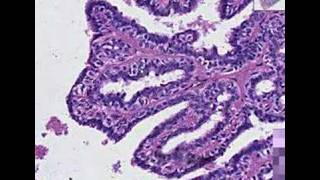 Histopathology BreastIntraductal papilloma [upl. by Bashuk]