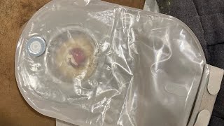 Stoma bag kaise change Kare   How to change stoma bag  Stoma bag kaise Lagate hai ostomytips [upl. by Swor]