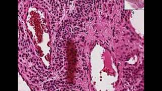 Histopathology SkinGlomus tumor [upl. by Armyn]