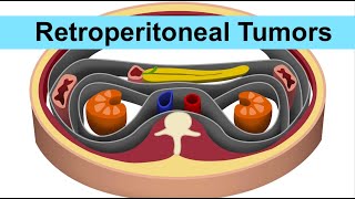 Retroperitoneal Tumors by ASM Minds Team [upl. by Agata]