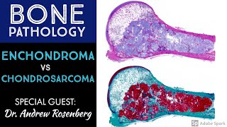 Chondrosarcoma vs Enchondroma Bone Pathology with Dr Andrew Rosenberg [upl. by Tulley91]