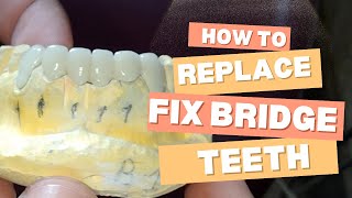 How to replace lower teeth crown bridge  tooth replacement  fix teeth  dental tooth replacement [upl. by Marlea807]