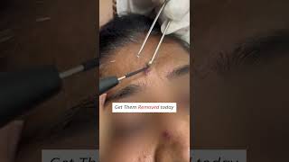 Warts Treatment  Warts Removal Procedure dermatologist skincare wartstreatment skinspecialist [upl. by Ossie]