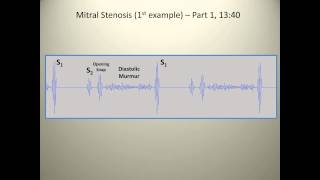 Examples of mitral stenosis murmurs [upl. by Fesuy]