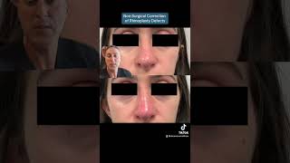 NonSurgical Correction of Rhinoplasty Defects [upl. by Odnaloy]