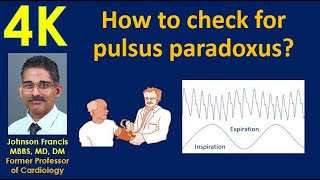 How to check for pulsus paradoxus [upl. by Iy]