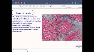 Pathology Hepatobiliary system 2 [upl. by Nanoc]