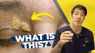 How to treat Xanthelasma  Dr Davin Lim [upl. by Allain]