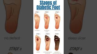 Health  Diabetic Foot [upl. by Ayamat8]