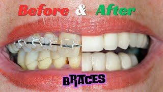 how to get braces step by step guide [upl. by Nnyllaf12]