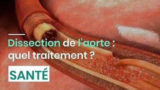 Dissection de l’aorte  quel traitement [upl. by Nava862]