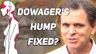 How To Fix Dowagers Hump [upl. by Atinel]