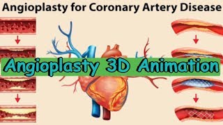 angioplasty angioplasty processangioplasty 3d animation [upl. by Nudd]