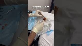 Satisfying Ingrown Hair Cyst Removals of 2024 cystpoping satisfyingvideo popit [upl. by Ramas]