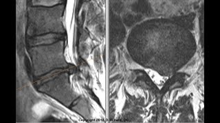 The Intervertebral Disc Deep Dive into the Nucleus Pulposus and Annulus Fibrosus  Annular Tear [upl. by Fry]