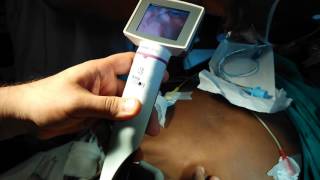 Awake Oral Intubation using King Vision video laryngoscope  Dr Mangal Dave [upl. by Ecnav]