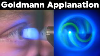 Goldmann Applanation Tonometry Procedure Technique Tutorial [upl. by Conrado]