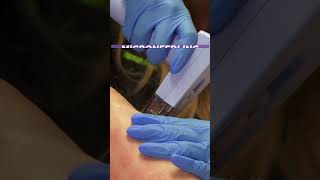 Morpheus 8 Radiofrequency Microneedling [upl. by Odrawde]