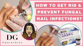 How to get rid and prevent toenail fungus [upl. by Gibun]